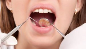 Sugarland tooth extractions